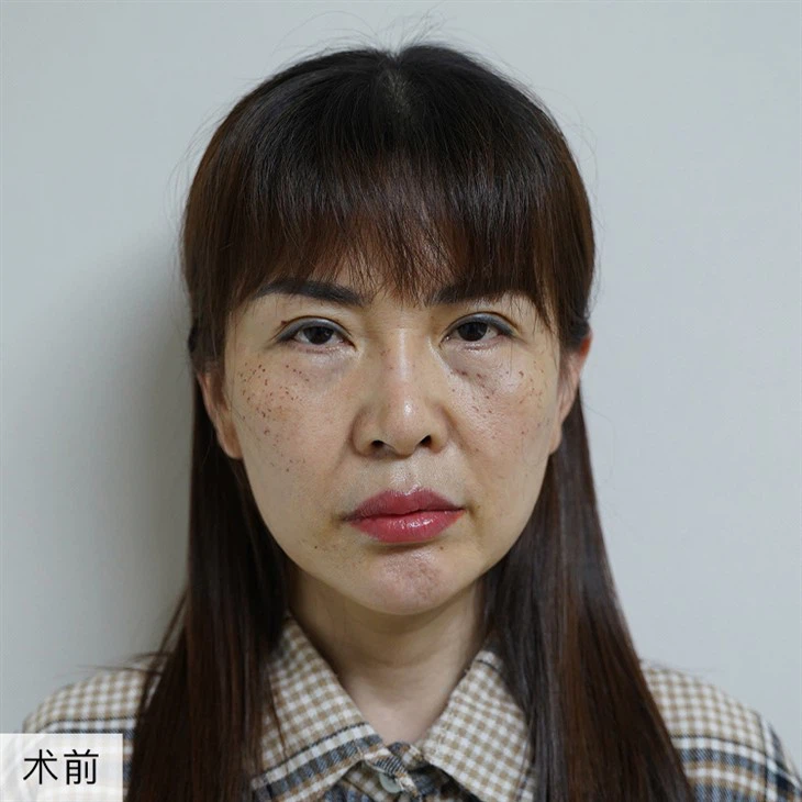 2Cheek Lift Surgery Prices