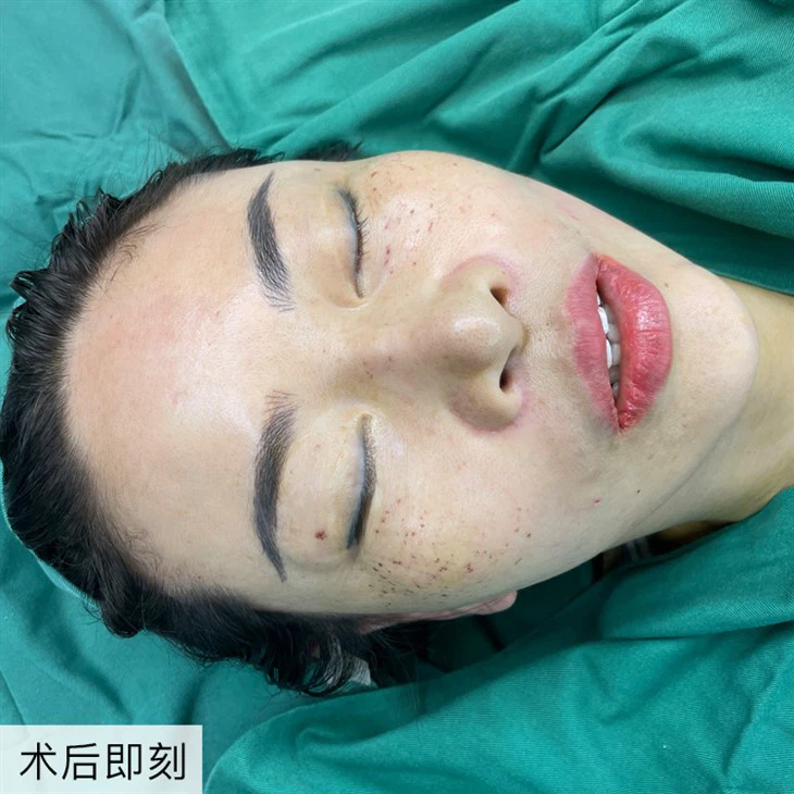 3Cheek Lift Surgery Results